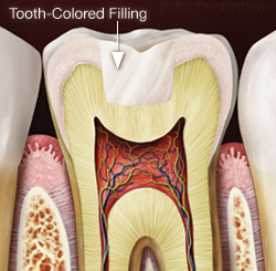 Tooth-Colored Filling.
